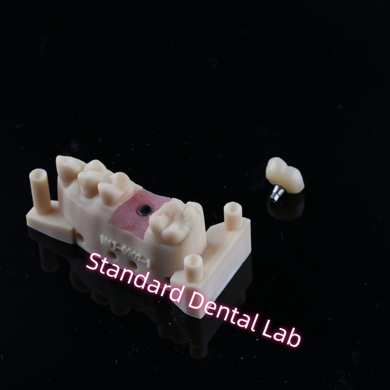 Custom Abutment Implant Crown Full Contour Zirconia Screw Retained