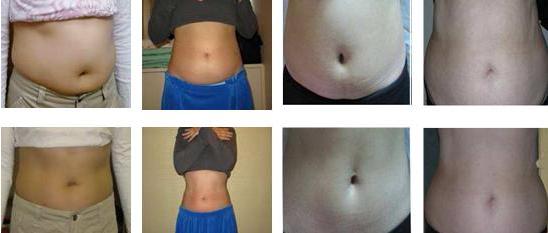 NUBWAY OEM 3 years warranty best result reduce 3-8cm Cryolipolysis Slimming Device