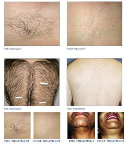 skin hair removal ipl professional 808nm laser hair removal for all skin types
