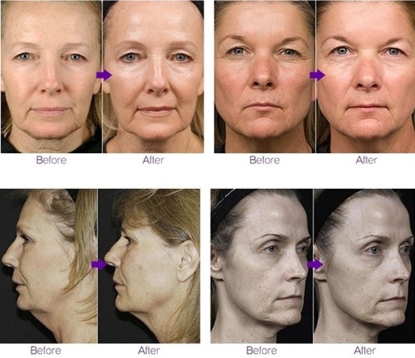 thermag before-after pics1.jpg