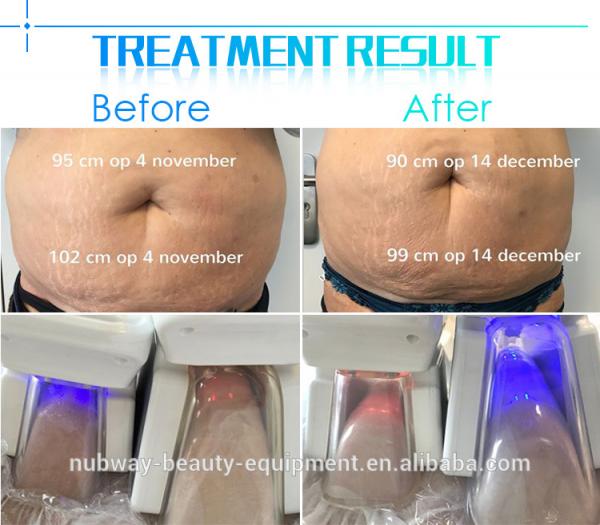 5 big cryo handles can work together body slimming cool lipo fat freezing