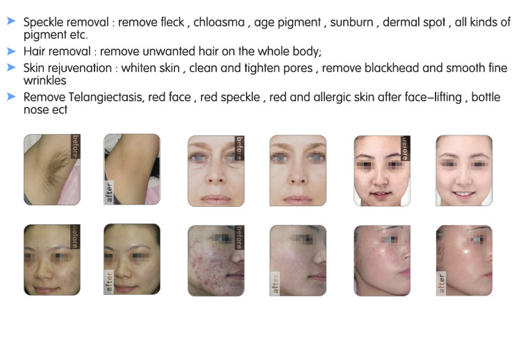 NUBWAY IPL laser/ ipl hair removal machine/fast permanent shr ipl skin rejuvenation
