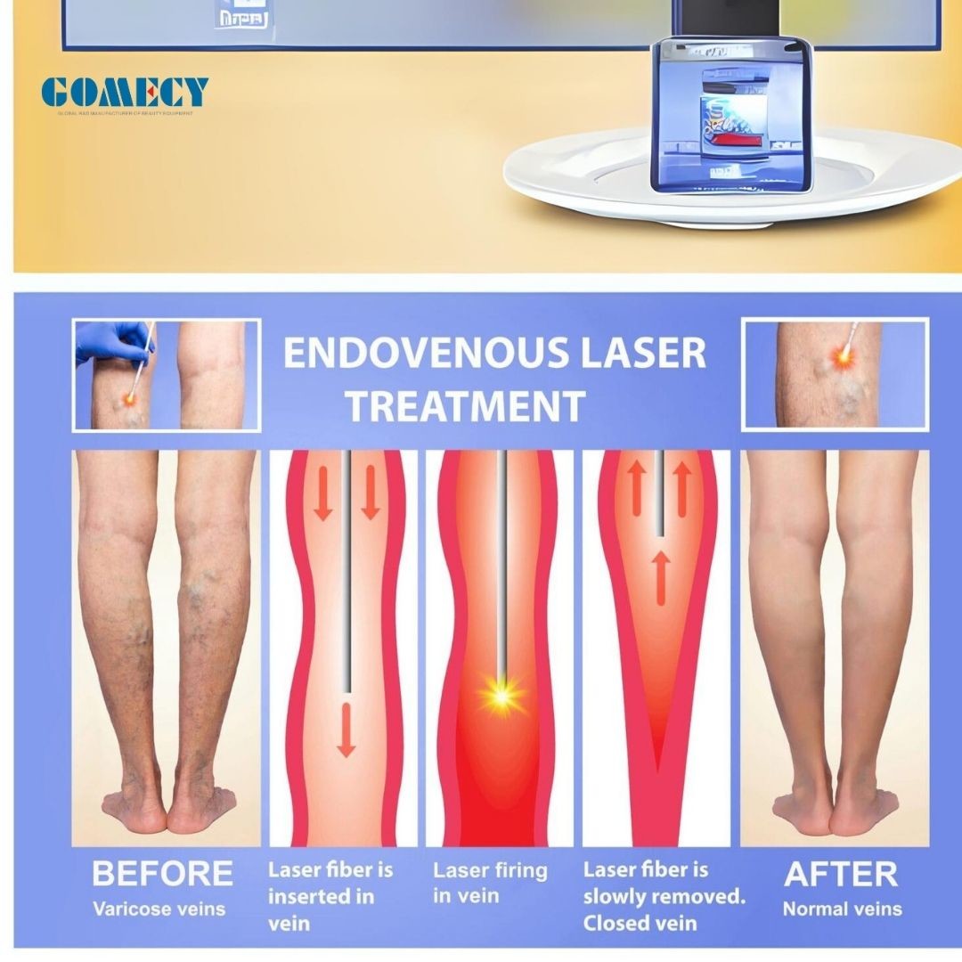 980 1470nm Diode Laser Optical Fiber Body Slimming Machine For Lipolysis Face Life Hemorrhoids