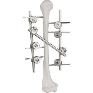 China Titanium Humeral External Fixation Device Orthopedic Surgical Implant wholesale