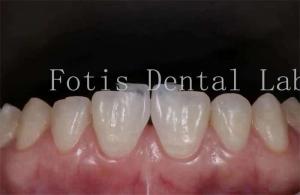 China Polishing Synthetic Dental Laminate Veneers High Stain Resistance wholesale
