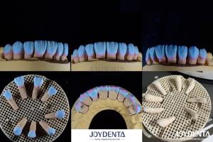 China High Biocompatibility Feldspathic Ceramic Veneer Glossy For Dental Restorations wholesale