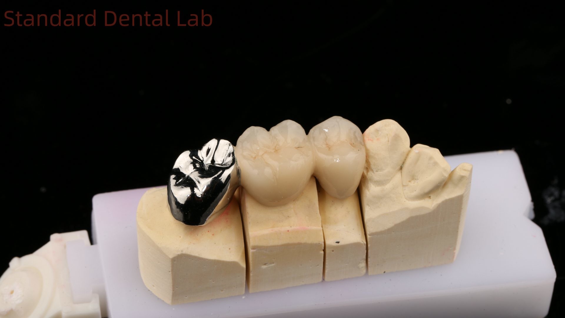 Vita Porcelian Full Metal Crown With Post Core 3 Years Guarantee from Dental Lab