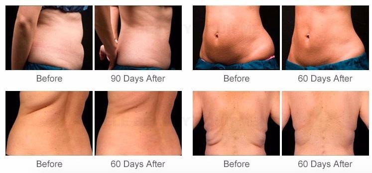 Cellulite 635nm Lipo Laser Slimming Machine 3Mhz Multipolar RF Instrument