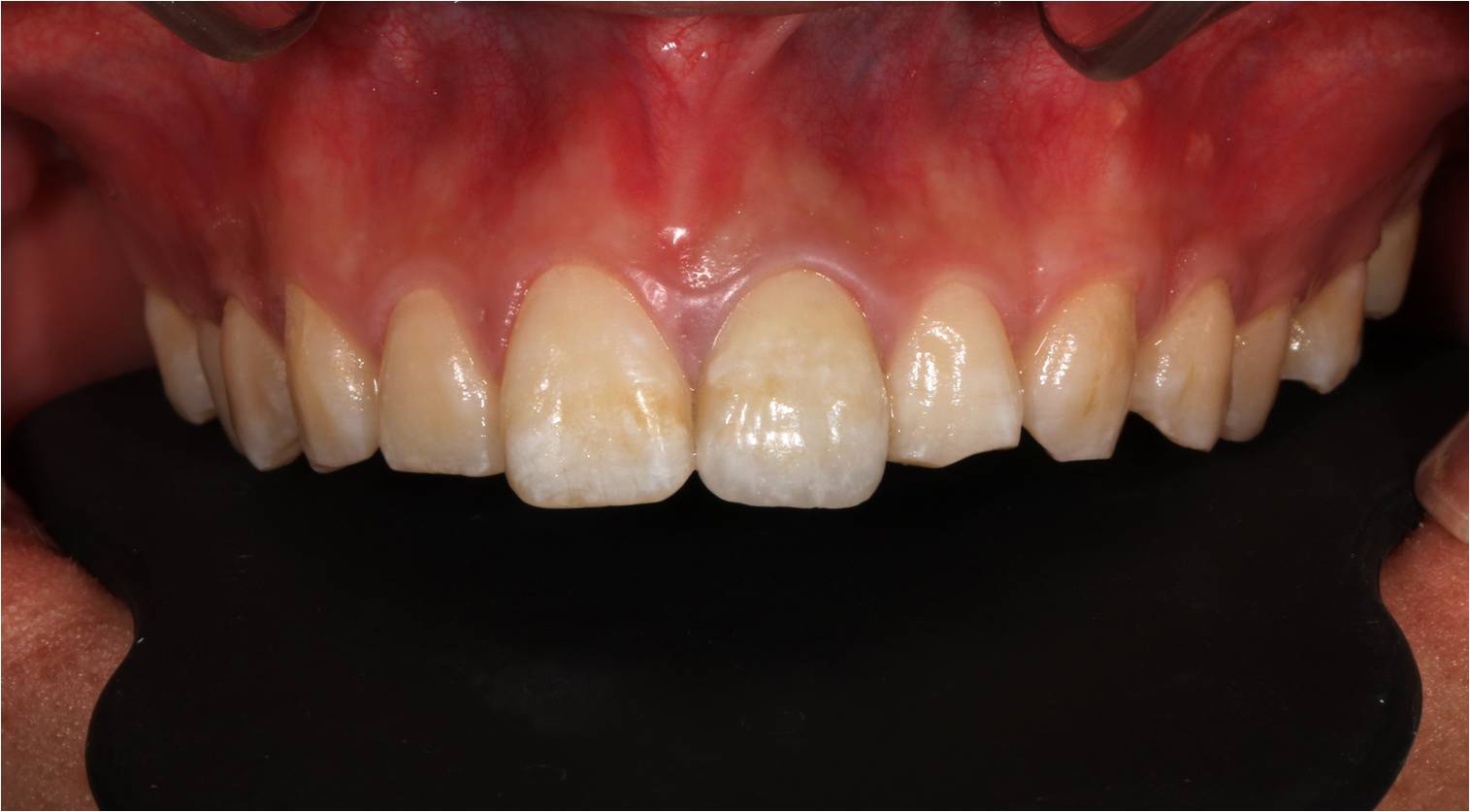 1100Mpa Pre Sintered Zirconium Oxide Ceramic