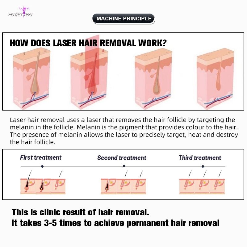 755nm 808nm 1064nm Diode Laser Hair Removal Beauty Machine 3500W All Skin Types