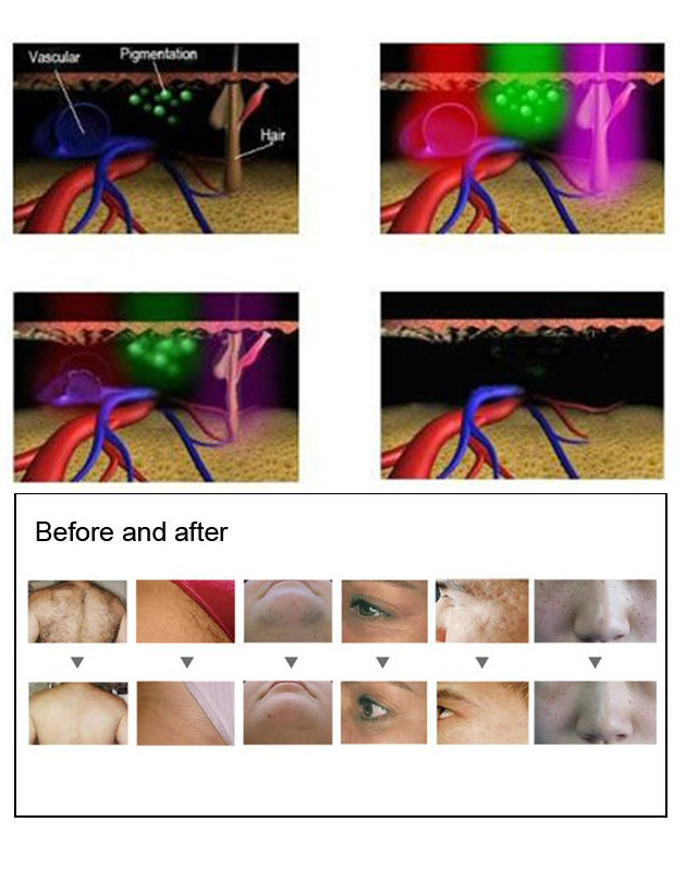 IPL SHR Diode Ice Laser Hair Removal 480nm For Home Use
