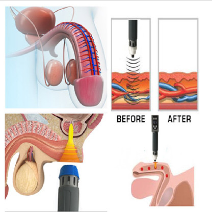 Home Use 5Hz Acoustic Shockwave ESWT Therapy Machine With Specially Designed Tips For Erectile Disfunction