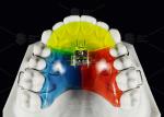 Stainless Steel Acrylic Screw Expander Orthodontic Treatment Removable