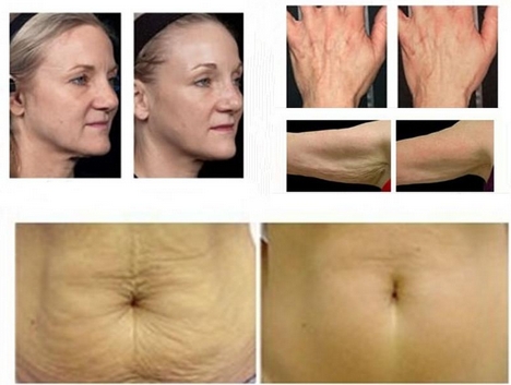 Most effective High Quality Thermage Skin Treatment Machine for Skin Treatment
