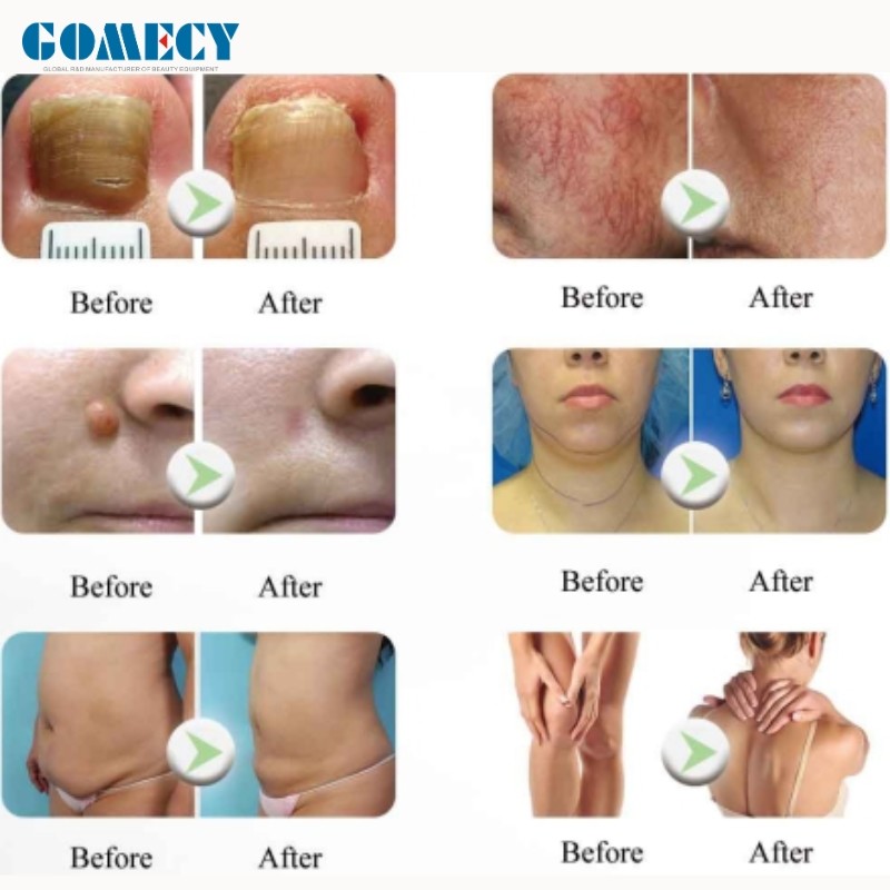 Gomecy 980nm Diode Laser Physiotherapy Machine Blue Light Therapy Pen Varicose Veins Laser Treatment Laser for Nails With Fungus