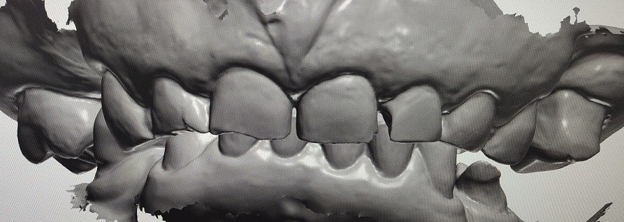 CAD CAM Design Digital Display Mockup Teeth Other Dental Products