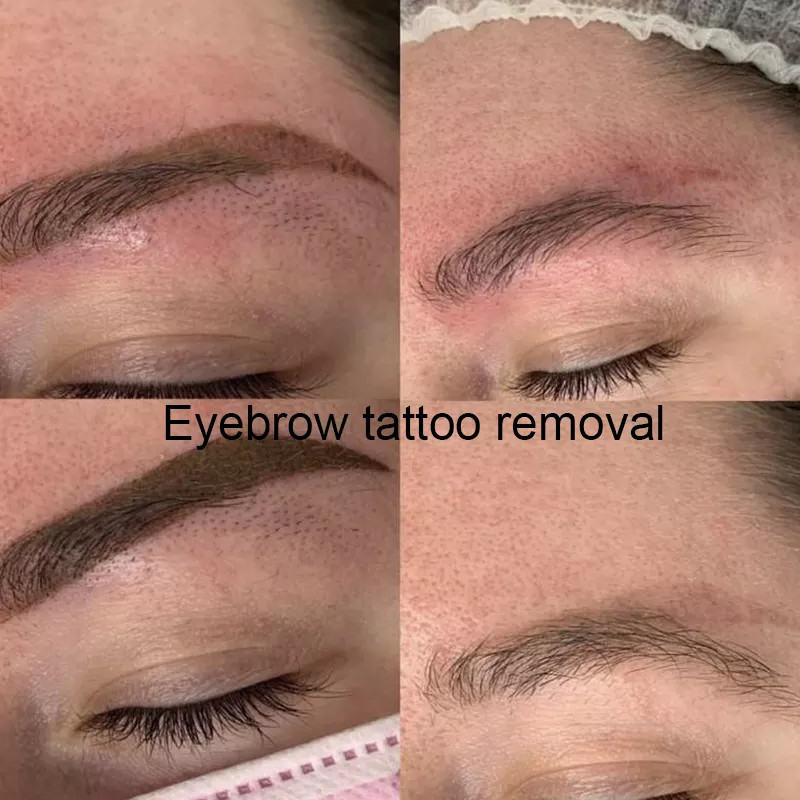 Multifunctional Picosecond Hollywood Diamond Carbon Peeling Sking Rejuvenation