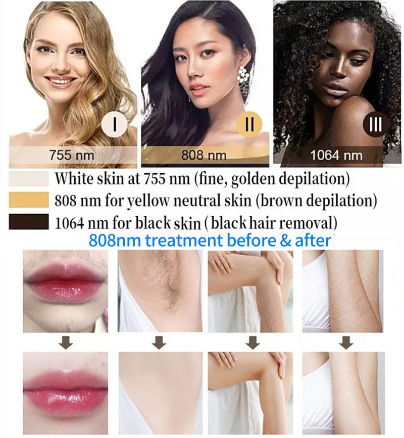755nm 1064nm 808nm Diode Laser Hair Removal Beauty Machine Professional