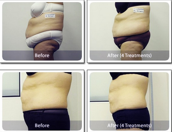 Hot selling!!! Laser Liposuction Beauty Equipment for Fat Reducing