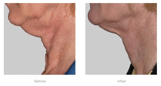 Elite Ultra 360_Before_and_After_Chin
