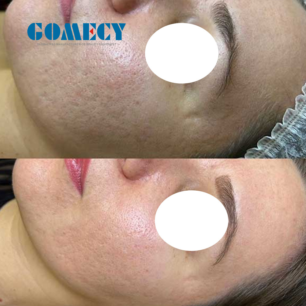 Picosecond Laser Tattoo Removal Machine Nd Yag Tattoo Remove Machine Picolaser Laser Pico Q-switch Carbon Laser Peel Machine