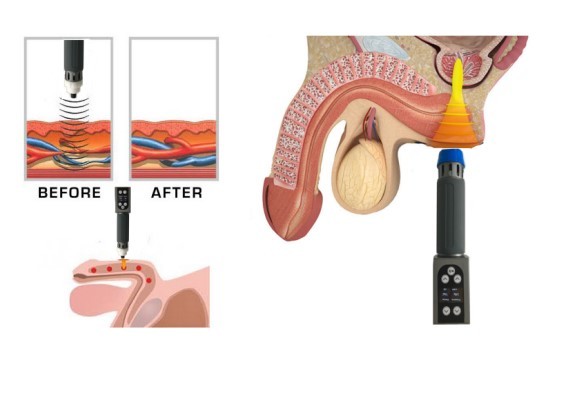 Low Intensity Shock Wave ESWT Therapy Machine ED Treatment/Cellulite Treatment