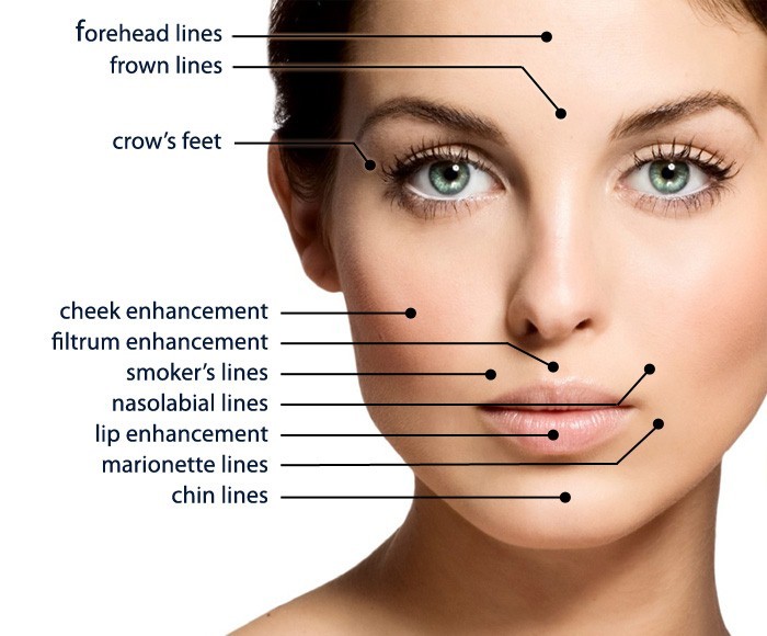 6D 8D 12D Pcl PDO Thread Lift Pcl Pdo Mono Threads Under Eyes