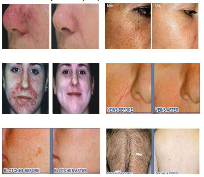 skin hair removal ipl professional 808nm laser hair removal for all skin types