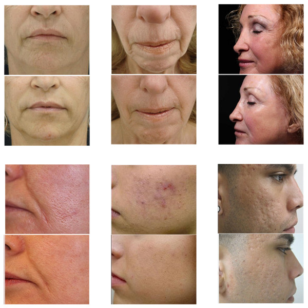 Fractional radiofrequency micro needling skin maintenance microneedle nurse system