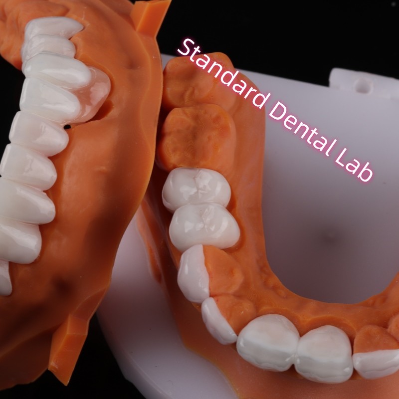 Lithium Dicilicate layer Ivoclar Emax Zirconia Laminate Veneers Translucent OEM ODM