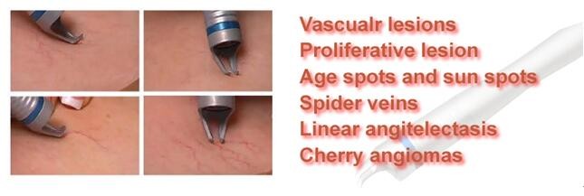 Vein Vascular removal equipment 980nm diode laser spider vein removal machine