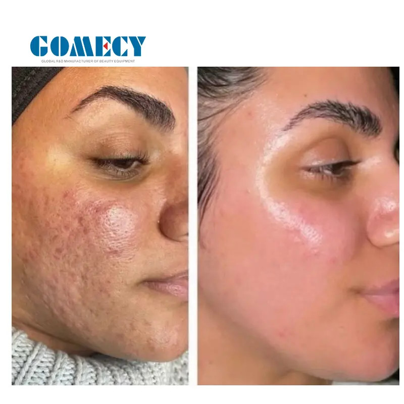Portable Morpheus8 Microneedle Rf Machine for Skin Tightening Fractional Skin Resurfacing