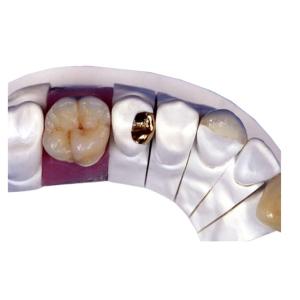 China PFM Porcelain Dental Crown wholesale