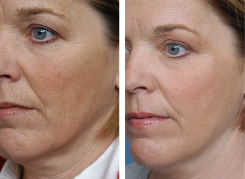 Clinic Salon Portable CO2 Fractional Laser Machine Beauty Salon Equipment For Acne Removal