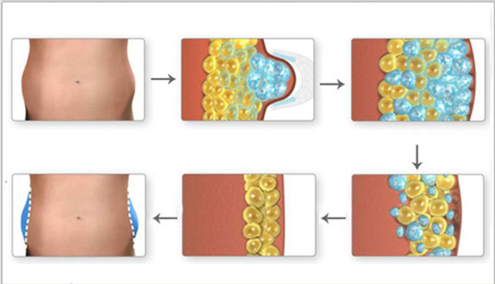 Non Invasive Cryolipolysis Fat Freezing Machine Human Engineering Design -5℃