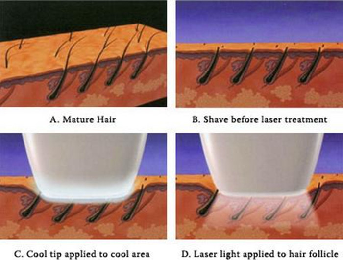 Permanent diode laser hair removal machine for Spa or Salon use