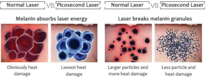 1064nm 2-10mm continuously adjustable  Spot  Pigmentation eraser Removal  Picosecond Laser Machine 4