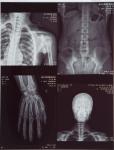 11X14 Inch Medical X-ray Film/Analogue Medical Film/Dry Film
