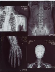 China 11X14 Inch Medical X-ray Film/Analogue Medical Film/Dry Film wholesale