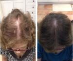 hair loss laser cap