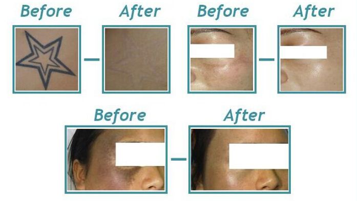 100-2000mj Photo Rejuvenation Machine 300w Nd Yag 1064 Laser