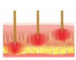 Fractional Rf Radio Frequency Skin Tightening Microneedle Machine For Beauty