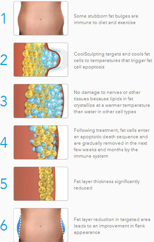 Cryolipolysis fat freeze slimming machine Cryo fat reduction device