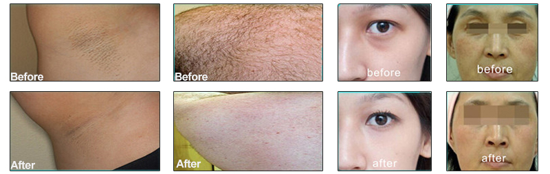 Portatil Diode Laser Hair Removal Machine 52kg Weight for Black Skin