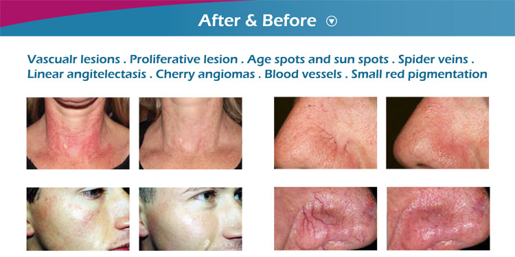 Medical CE approved 980nm laser diode spider vein laser removal for facial and legs