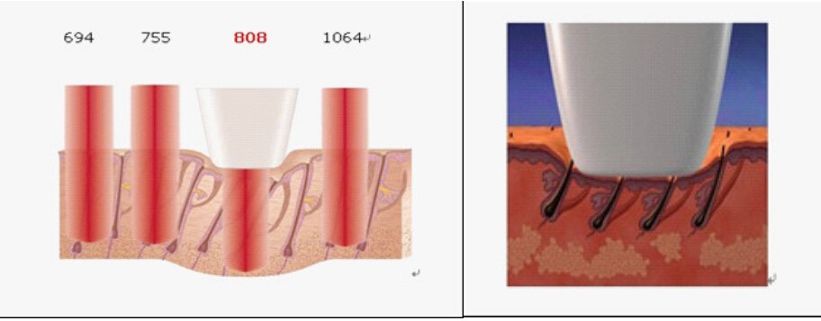 Factory price 810nm diode laser permanent hair removal 808nm on sale