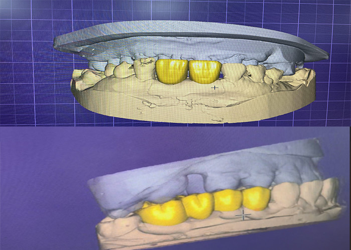 Customized Aesthetic Zirconia Dental Crown Perfectly Fitted for Anterior and Posterior Teeth