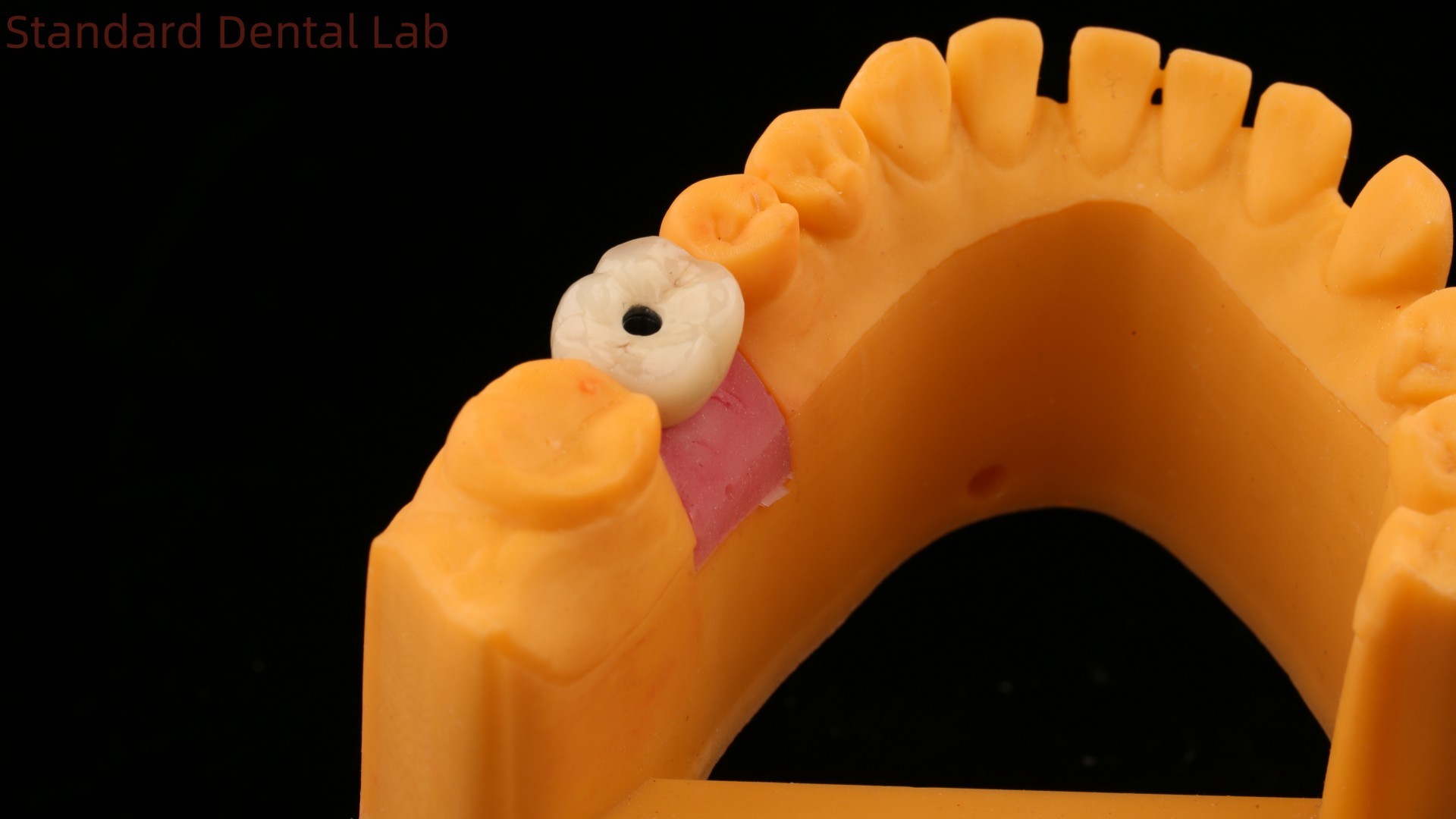 Screw Retained Dental Implant Crown Dental PFM Crown With 3D Print Model