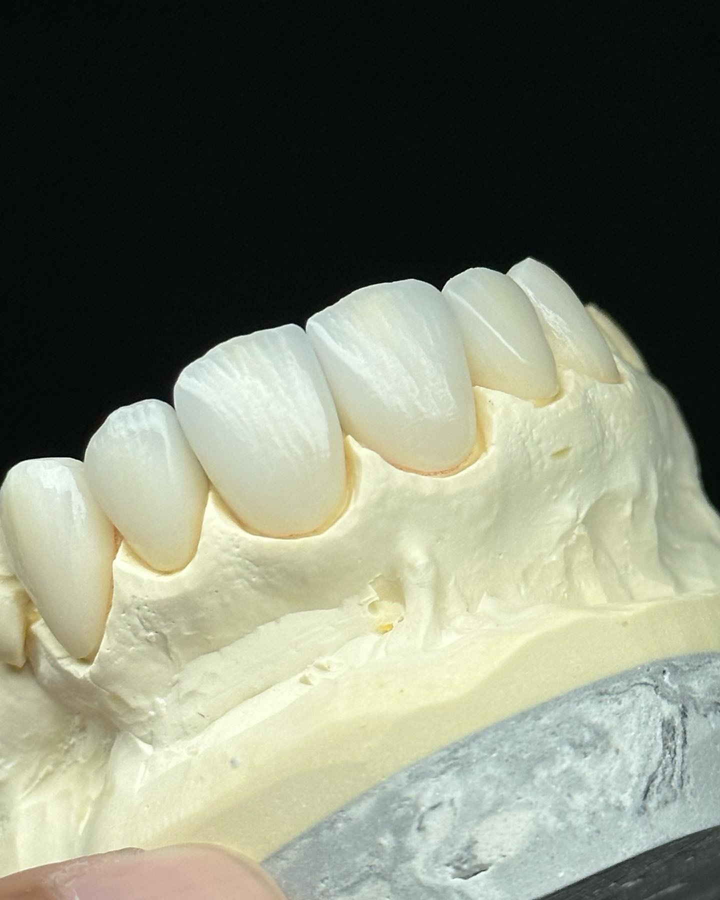 Transluency Layered Zirconia Crown for Optimal Functionality and Natural Aesthetics