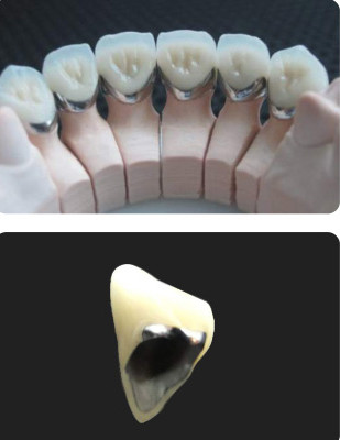 Porcelain Fused To Metal PFM Crown Dental Wear Resistance For Restorative